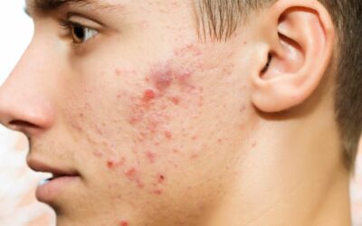 Le gel nettoyant visage La Roche-Posay Effaclar : un allié contre l’acné